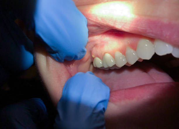 Best Emergency Dental Care for Broken or Chipped Teeth in Oasis, CA